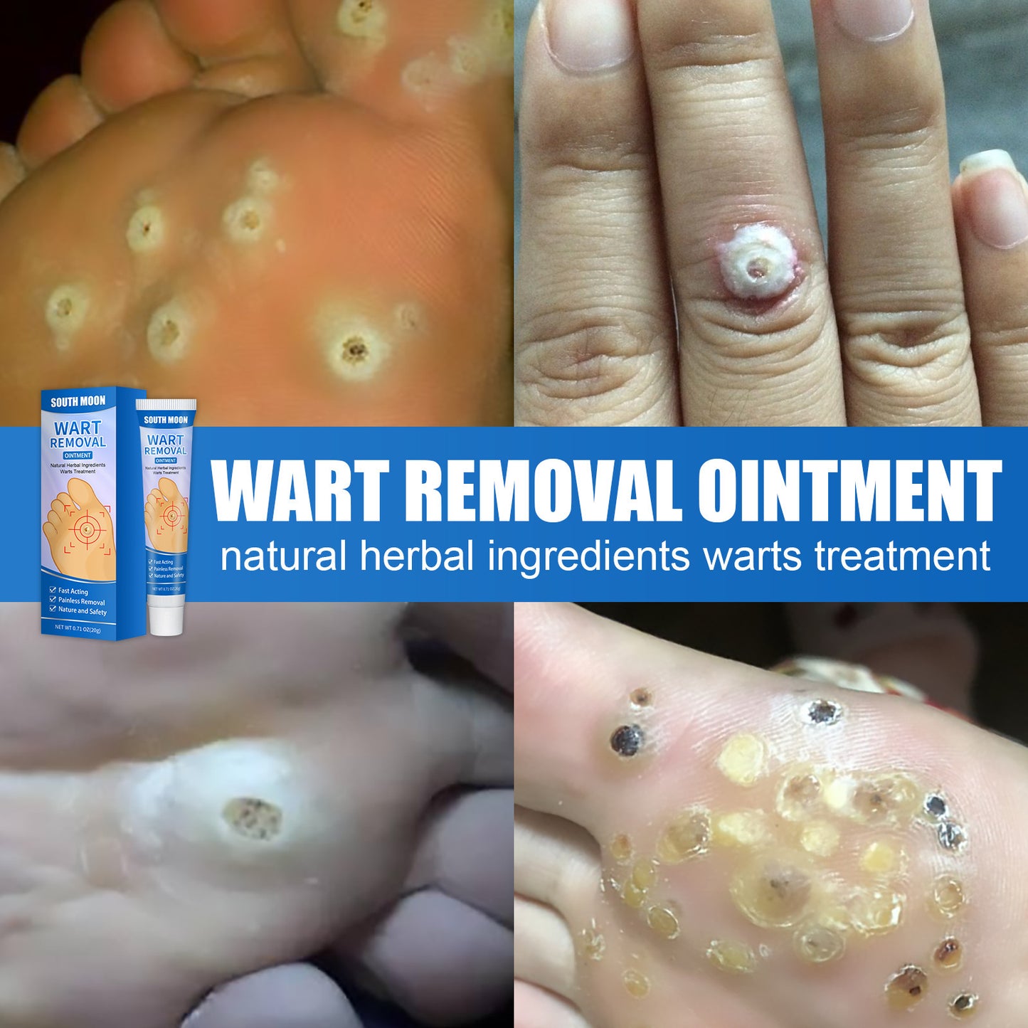 Remove Corns Cream To Smooth The Calluses