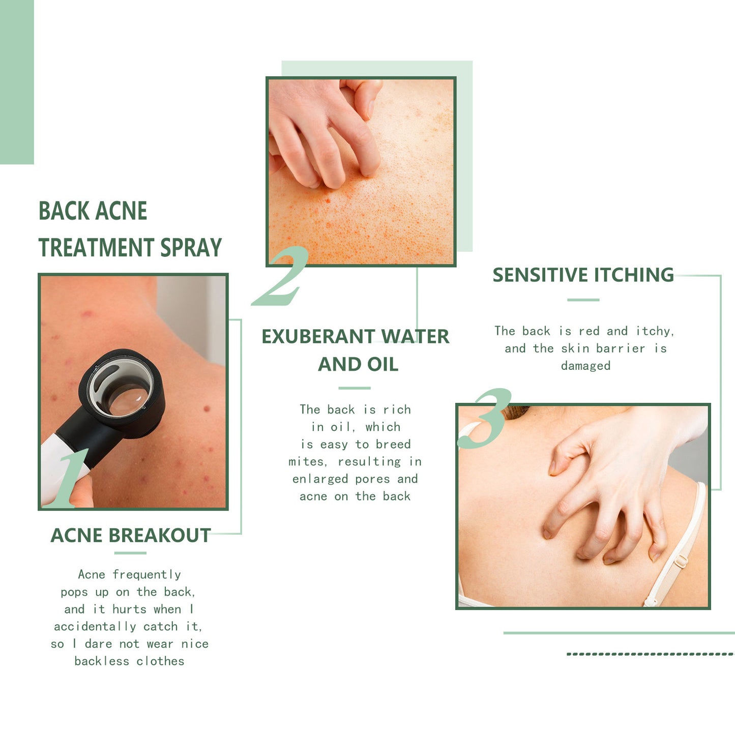 Back Acne Repair Back Shoulder Acne Desalination Acne Mark Skin Care Spray